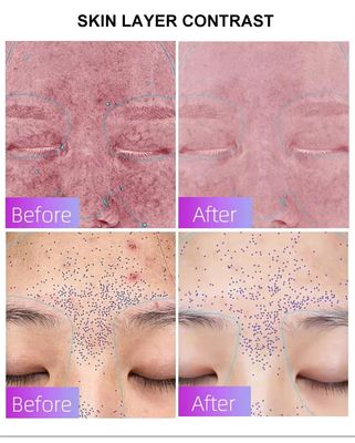 購入 Blue Light Acne Treatment Mask with Intelligent Timer – Manufacturer Direct Supply, Appearance Patent Included オンライン製造